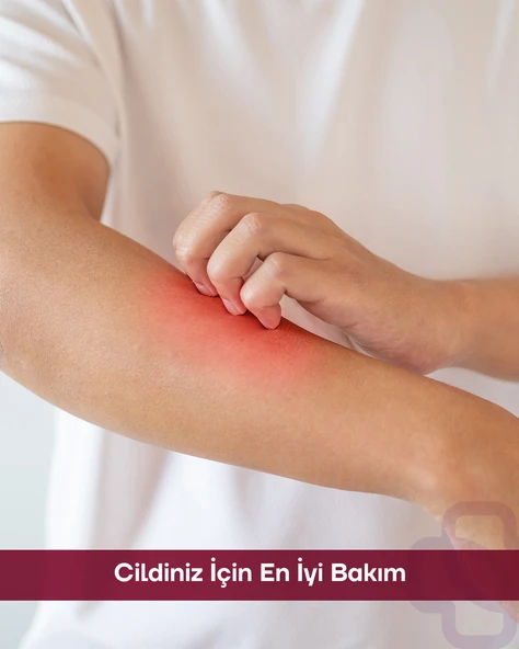 Sante Plus +SOS Recuops Yatıştırıcı Bariyer Onarıcı Cilt Bakım Kremi 125 ML ( Egzama, Sedef, Kaşıntı ) - 6