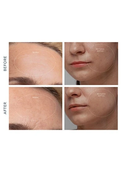 Foreo Kiwi Derma Cilt Masaj Aleti - 2