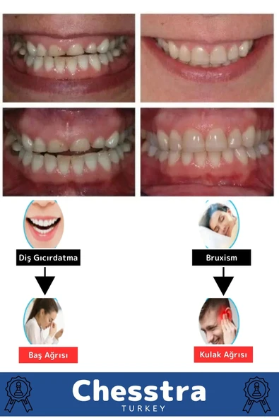 Kutulu Diş Çene Sıkma Gıcırdatma Gece Plağı Koruyucu Önleyici Dişlik Uyku Silikon Aparatı 4 Adet - 4