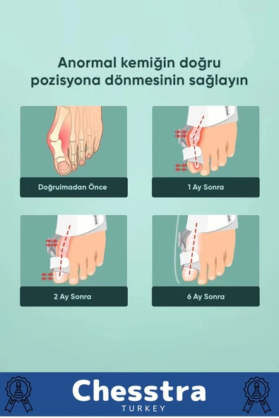 Yumuşak Yıkanabilir Bedensiz Koruma Aparat Sağ Sol Ayak Uyumlu Baş Parmak Kemik Düzeltici 4 Adet - 2