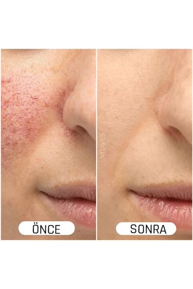 VITAYES C Vitamini %10 Ve Hyalüronik Asit Aydınlatıcı Cilt Tonu Eşitleyici Cilt Serumu Ikili Avantajlı Set - 3