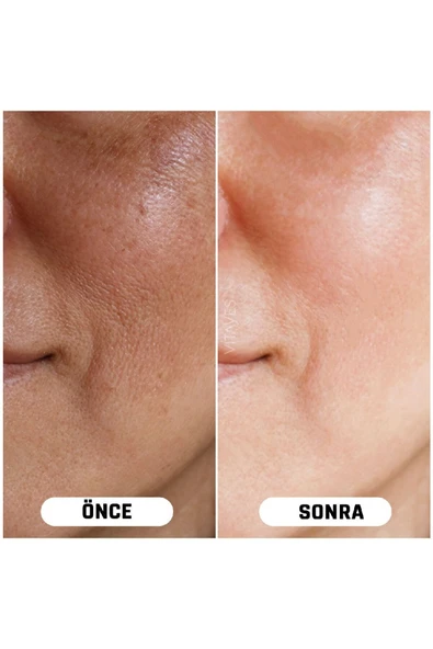 VITAYES C Vitamini %10 Ve Hyalüronik Asit Aydınlatıcı Cilt Tonu Eşitleyici Cilt Serumu Ikili Avantajlı Set - 2