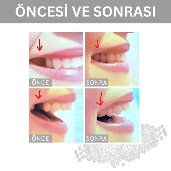 Moldable Vivostar Takma Diş, Protez Diş, Diş Dolgusu, Geçici Diş, Diş Onarımı - 2