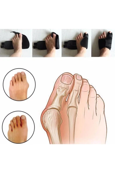 Ayak Ateli Ayak Baş Parmak Bunyon Koruyucu 1 Çift (SAĞ VE SOL) (Gece Ateli EX-89)