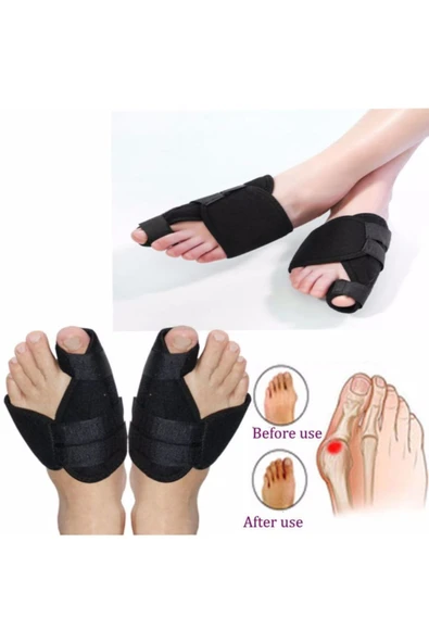 Ayak Ateli Ayak Baş Parmak Bunyon Koruyucu 1 Çift (SAĞ VE SOL) (Gece Ateli EX-89) - 4