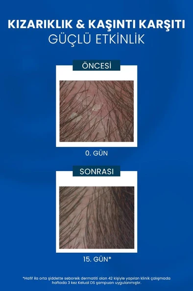 DUCRAY Kelual DS Şampuan İnatçı ve Şiddetli Kepek Şampuan 100ml - Resim 4