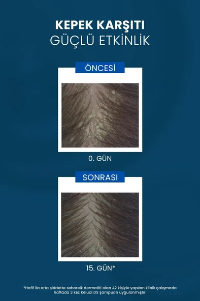 DUCRAY Kelual DS Şampuan İnatçı ve Şiddetli Kepek Şampuan 100ml - Resim 3