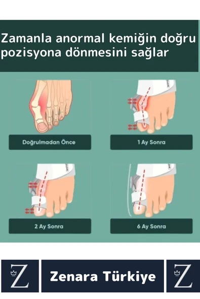 Premium Sağ Sol Her İki Ayak İçin Uyumlu Yıkanıp Kolay Temizlenir Baş Parmak Kemik Düzeltici Atel - 4