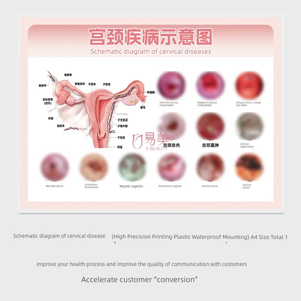 Jinekolojik Anatomi Atlası Poster - Servikal Hastalık Şematik Diyagramı - A4