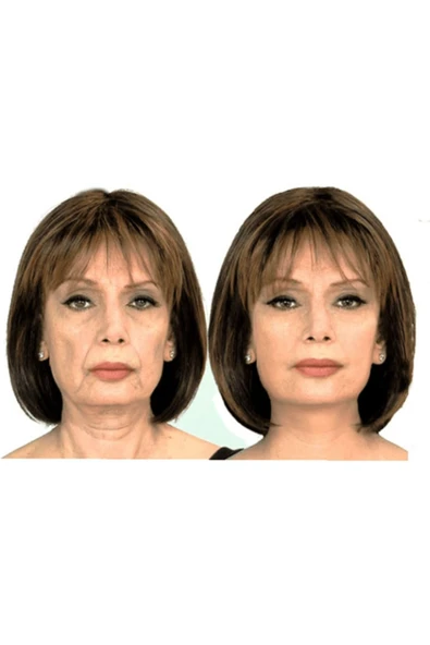 MEGEV Yüz Gerdirme Bandı Kırışıklık Oluşumunu Engelleme Bandı Yüz Germe 5cm 5 Mt - Resim 2