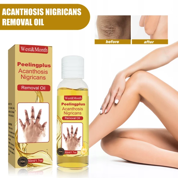 Acanthosis Nigricans Giderici Yağ - Cilt Beyazlatıcı ve Nemlendirici - 50ml