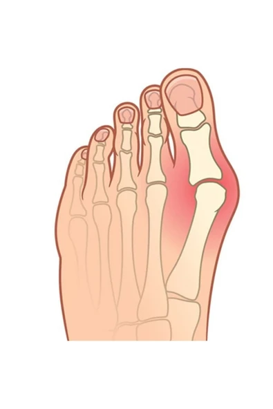 APS Silikon Parmak Arası Makara Halluks Valgus Yüksek Kalite - 4
