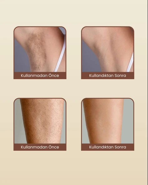 Mieco Safir Soğutma Özellikli ipl Lazer Epilasyon Aleti (Safir Cam)-Rosegold + Gözlük ve Çanta Hediyeli - 6