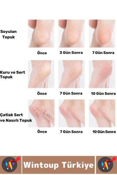 Unisex Ergonomik Konforlu Kaymaz Ağrı Azaltan Esnek Silikon Nemlendirici Topuk Çorabı - 4