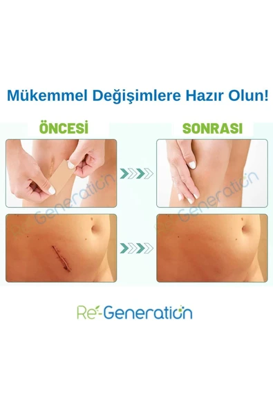 RE-GENERATION Silikon Sheet - Silikon Jel Tabaka -doğum Sonrası Izleri Giderir - Ameliyat Izleri 15x4,0x0,1 Cm - 6