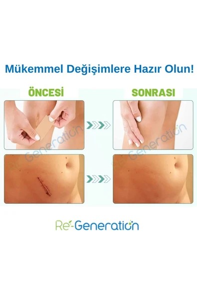 RE-GENERATION Silikon Sheet - Yara Bakımı, Yanık Izi, Ameliyat Izi, Akne Izi Gidermeye Yardımcı- 7x2x0,1 Cm - 4