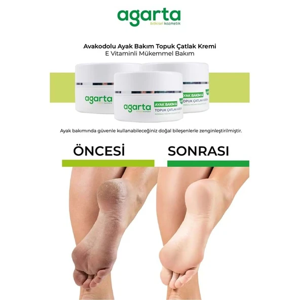Agarta Ayak ve Topuk Çatlak Bakım Kremi 100ML (3 Lü Set) - Resim 4