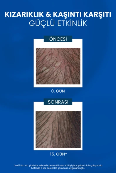 Ducray Kelual Ds İnatçı Kepeğe Karşı Şampuan 100 ml - 4