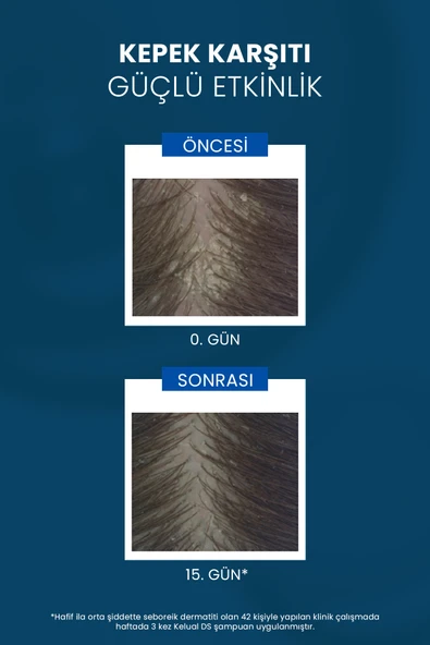 Ducray Kelual Ds İnatçı Kepeğe Karşı Şampuan 100 ml - 3