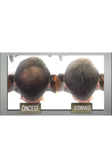 Saç Fiberi Toz Keratin Içeri Siyah 50 gr X 3 Adet - 2