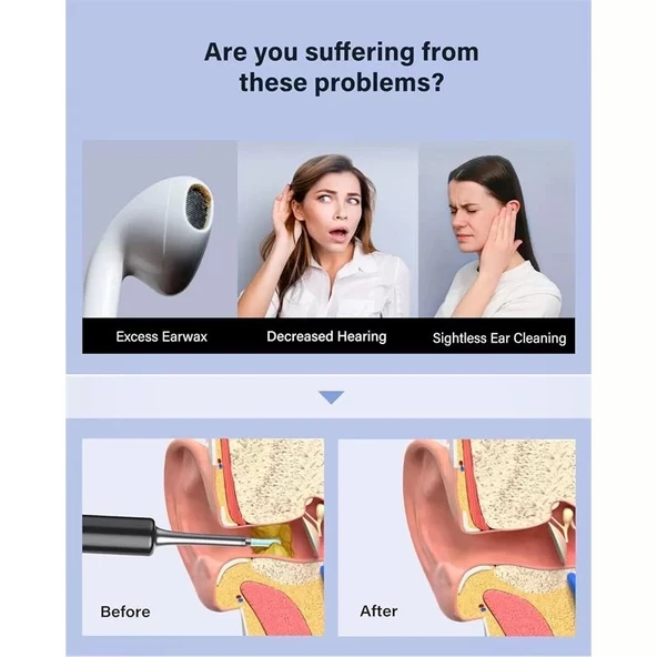 Bebırd T5 3mp Kamera 3.5mm Lens Şarjlı Wıfı Görüntülü Kulak Temizleyici Siyah Renk - 2