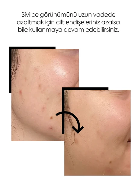 Clasy Care, Face Up Skin, Sivilce ve Akne Kremi - 40 ml - Resim 2