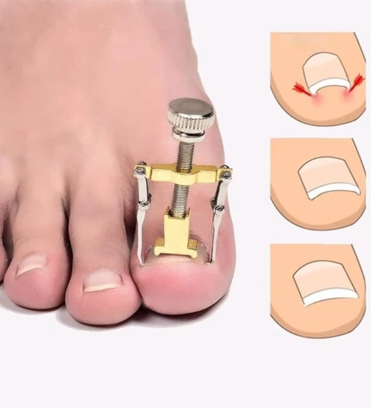 Batık Tırnak Çıkarma Aparatı - 3