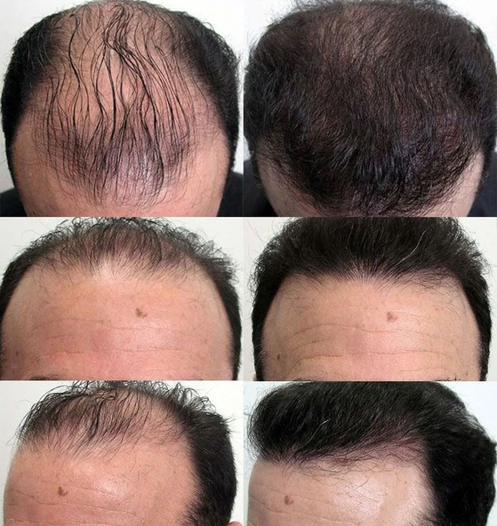 RollerOn Hair-Derma Roller Saç için Titanyum Mikro İğneli 2.00mm Saç Roller - 3