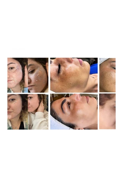 Moreno Care prenses bakım protokolü - Resim 4