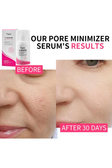 TWG Azelaik Asit Temizleme Losyonu 100g - 3