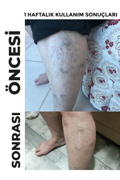 DERMONEM Venoplus Kremi - 3