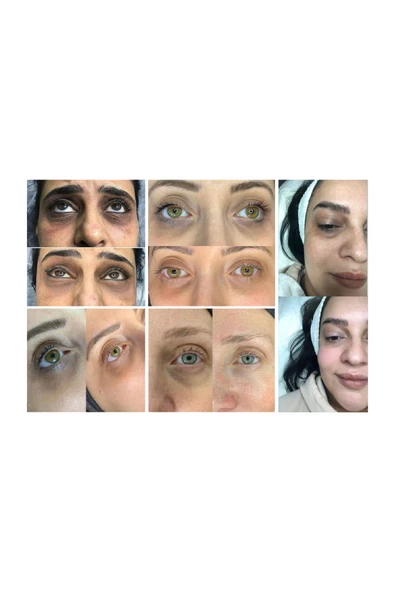 anka lazer 4 aşamalı göz altı morluk protokolü uygulaması krem serum vitamin tam profesyonel ithal - Resim 4