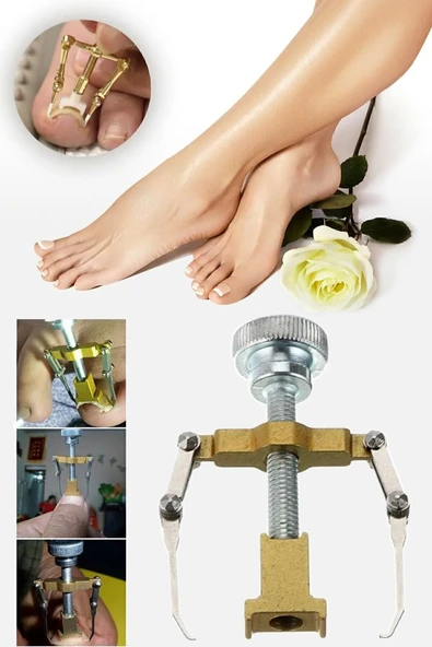 Batık Tırnak Çıkartıcı Ayak Tırnak Batması Düzeltici Pens Aparat ürün görseli 1