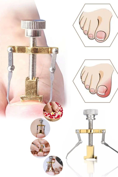 Batık Tırnak Düzeltme Aleti Batık Tırnak Çıkartıcı Aparat Ayak Tırnak Batması Pens Aparat - Resim 3