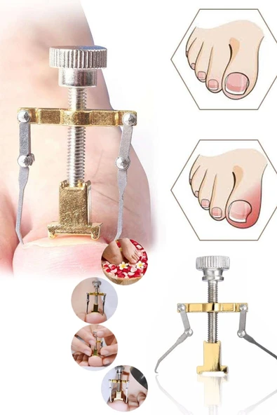 Batık Tırnak Düzeltme Aparatı Batan Tırnak Düzeltme Aleti Tırnak Batması Düzeltme Aleti Free Kargo ürün görseli 1