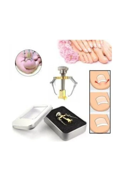 Batık Tırnak Çıkartıcı Ayak Tırnak Batması Düzeltici Pens Aparat - Resim 3