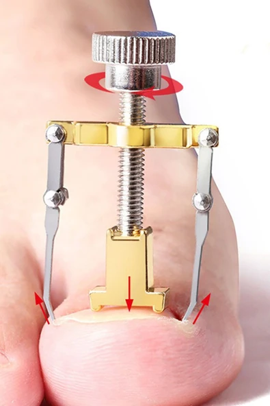 Batık Tırnak Düzeltme Aparatı Batan Tırnak Düzeltme Aleti Tırnak Batması Düzeltme Aleti Free Kargo - Resim 3