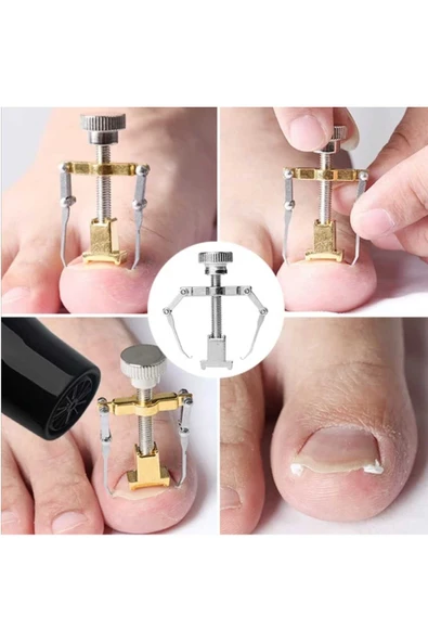 1 Adet Batık Tırnak Düzeltme Aleti Batık Tırnak Çıkartıcı Aparat Ayak Tırnak Batması Pens ürün görseli 1