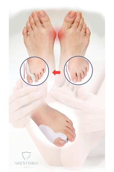 Çift Makaralı Bunyon Baş Parmak Düzeltici Ateli Kemik Koruyucu Küçük 2'li Fc-007 - Resim 5