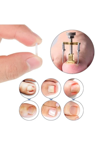 Batık Tırnak Düzeltme Aleti Batık Tırnak Çıkartıcı Aparat Ayak Tırnak Batması Batık Tırnak Aleti ürün görseli 1