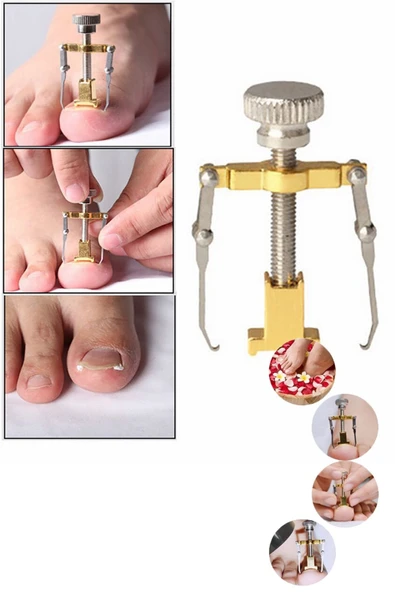 Batık Tırnak Düzeltme Aparatı Batan Tırnak Düzeltme Aleti Tırnak Batması Düzeltme Aleti Free Kargo - Resim 2