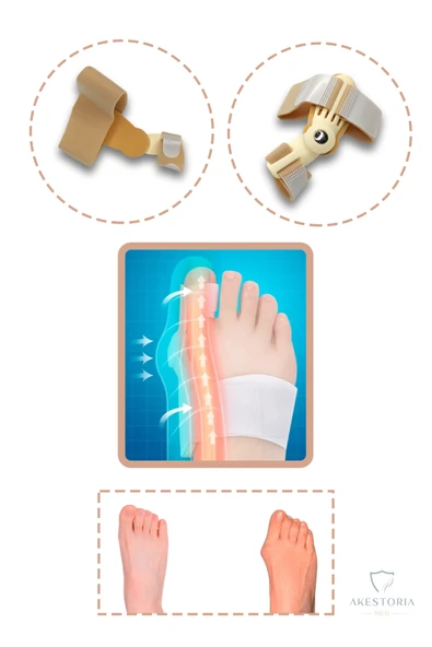 Ayarlanabilir Cırtlı Baş Parmak Kemik Sönger Düzeltici FC-053 - Resim 2