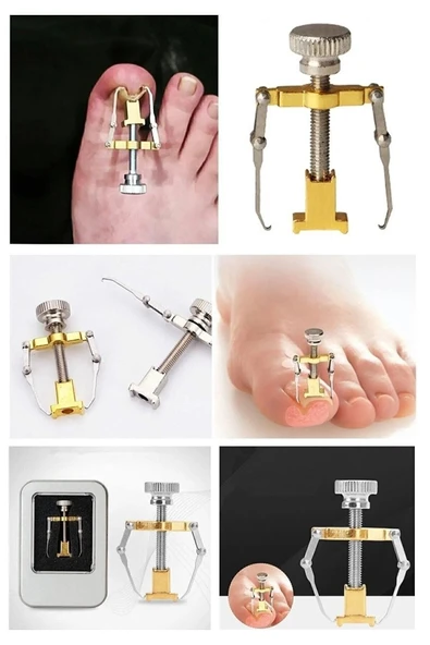 Batık Tırnak Çıkartıcı Ayak Tırnak Batması Düzeltici Pens Aparatı Orjinal Tırnak Çekme - Resim 2