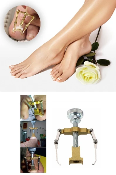 Ayak Tırnak Batması Ağrısı İçin Batık Tırnak Çıkartıcı Aparat - Resim 5