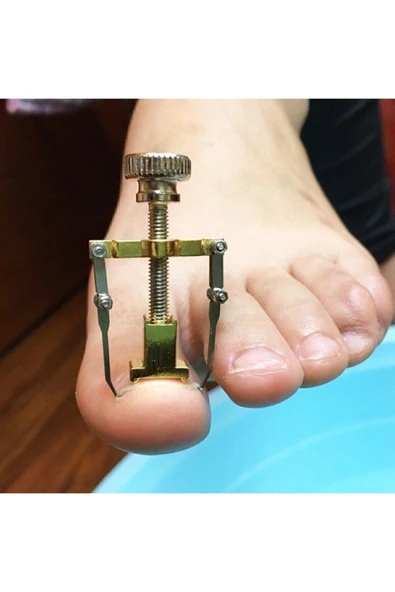 Batık Tırnak Çıkartıcı Ayak Tırnak Batması Düzeltici Pens Aparat - Resim 4
