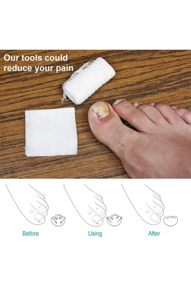 Batık Tırnak Düzeltme Aleti Batık Tırnak Çıkartıcı Aparat Ayak Tırnak Batması Batık Tırnak Aleti - Resim 6