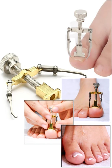 Batık Tırnak Düzeltme Aleti Batık Tırnak Çıkartıcı Aparat Ayak Tırnak Batması Pens Aparat - Resim 4