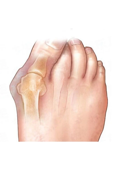 2'li Set Ayak Parmak Bunyon Kemik Koruyucu Makaralı Halluks Valgus - Resim 2