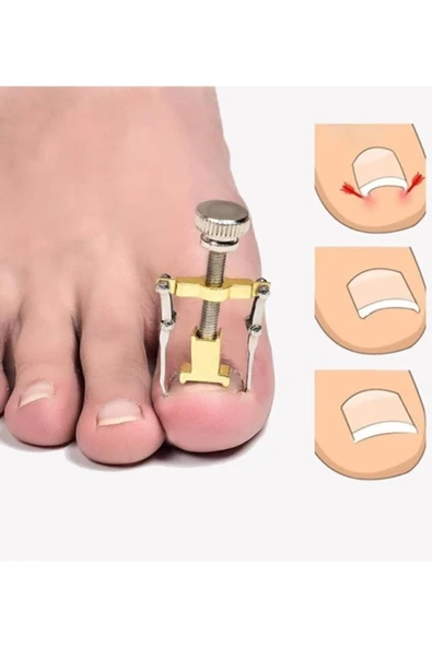 Batık Tırnak Çıkartıcı Ayak Tırnak Batması Düzeltici Pens Aparat - Resim 3