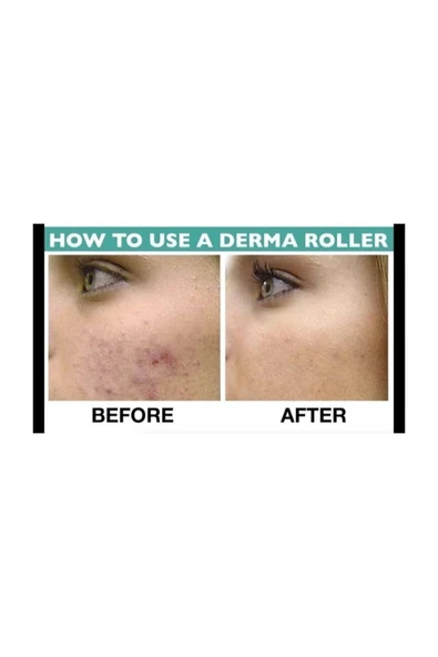 Skin Dermaroller 1.00 Mm 540 Iğneli Saç Ve Cilt Roller - Resim 3